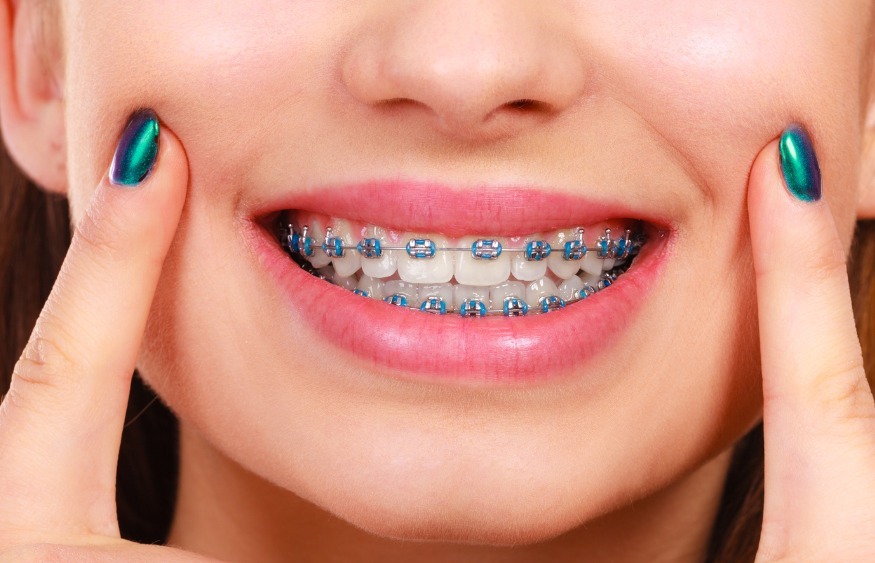 Dental Braces Treatment